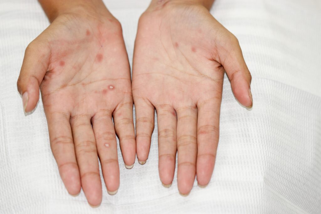 Two hands with light skin tone. They are palm up and you can see small sores on their palms and fingers. They are syphilis sores.